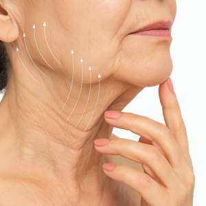 Close-up of the neck and jawline showing lift direction for a Mini Facelift and Neck Lift